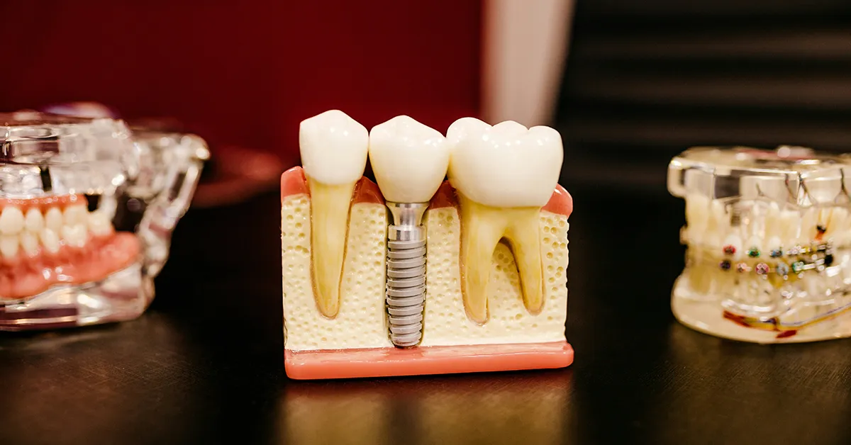 Zubni implantati